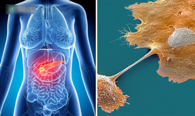 6 dấu hiệu của ung thư tuyến tụy: Căn bệnh cực nguy hiểm vì tỷ lệ sống sót chỉ còn 8,5%