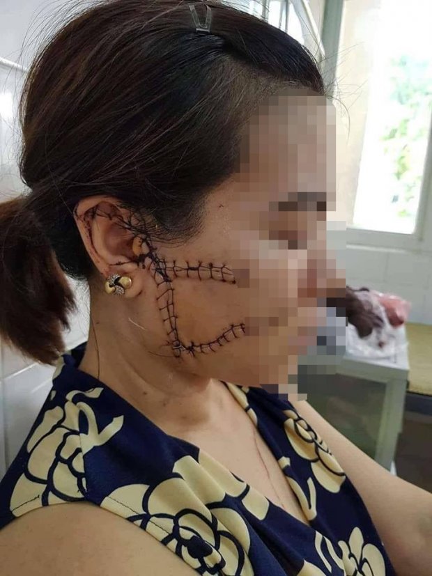 Nỗi đắng cay tủi nhục của người vợ bị chồng cầm dao rạch mặt, cắt gân chân vì nổi cơn cuồng ghen