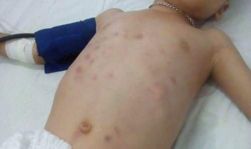 Trận đòn trong bữa ăn khiến bé 6 tuổi bị đa chấn thương, thủng ruột