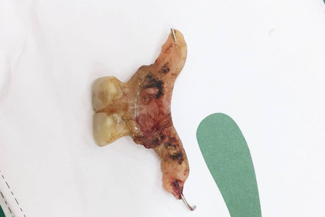 Suýt chết vì thủng ruột do nuốt phải... răng giả