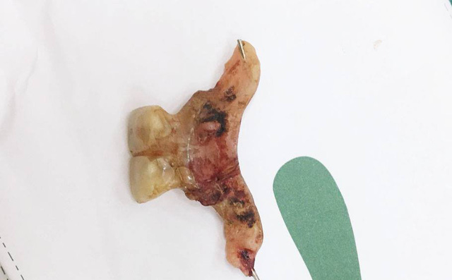 Suýt chết vì thủng ruột do nuốt phải... răng giả