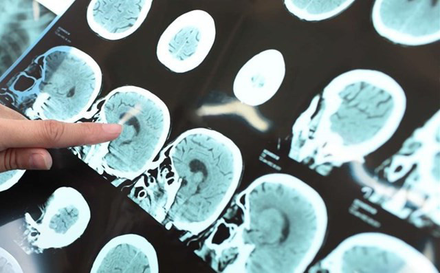 Đột quỵ não: Không còn chỉ người già, càng ngày thanh niên ngoài 20 càng hay mắc phải Đột quỵ não: Không còn chỉ người già, càng ngày thanh niên ngoài 20 càng hay mắc phải