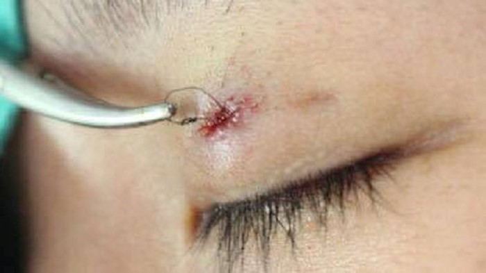 Nhấn mí mắt thẩm mỹ, sau 1 năm sợi chỉ lồi ra ngoài gây nhiễm khuẩn