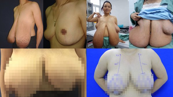 Ngực quá khổ 1,1m như hotgirl Hải Dương, người phụ nữ nhiều lần ngã sấp mặt