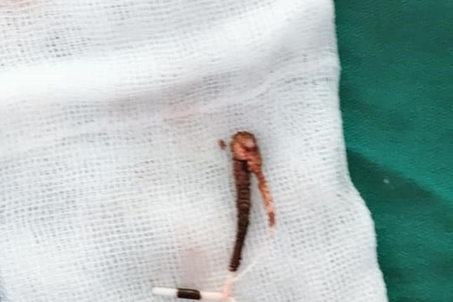 Vòng tránh thai du lịch vào ổ bụng