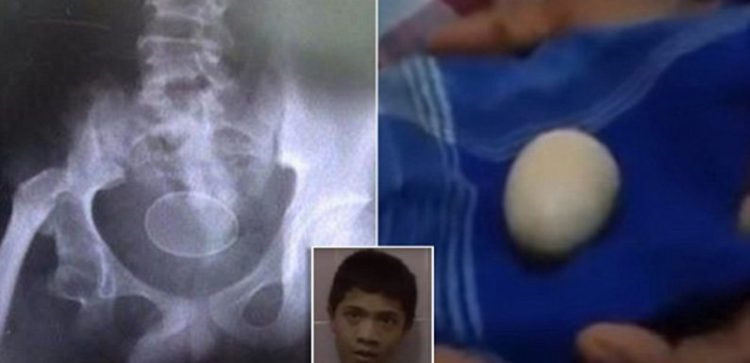 Sự thật bí ẩn gây sốc cậu bé biết đẻ trứng ở Indonesia