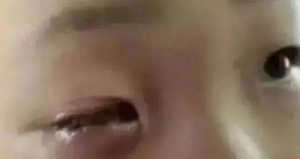 Bé trai mù mắt vì nghịch ngợm gói hút ẩm, đồ vật này tuyệt đối để xa tầm tay trẻ