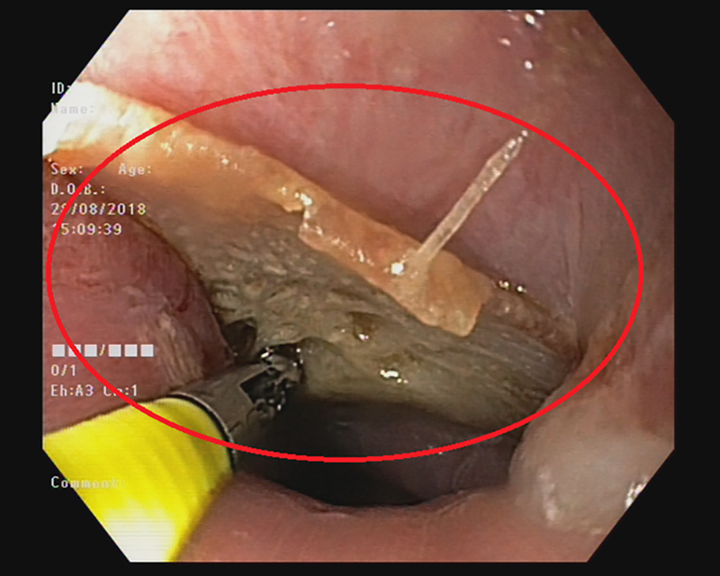 Hóc xương cá đúng lúc quả bóng vàng của U23 Việt Nam sút tung lưới U23 Syria