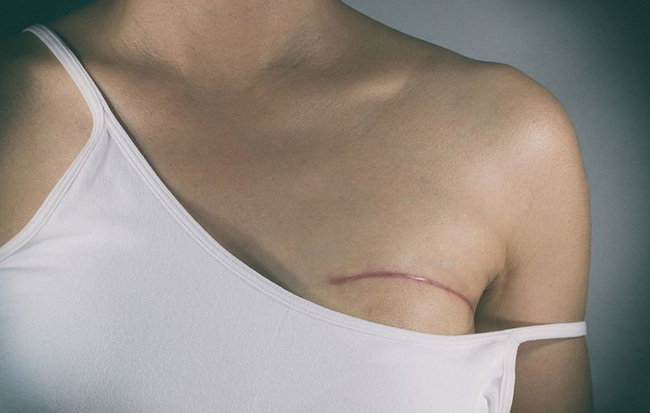 Chủ quan khi thấy vết ố màu xanh lá dính ở mặt trước của áo sơ mi, người phụ nữ giật mình khi biết đã bị bệnh nặng