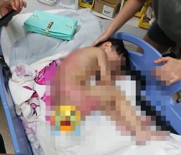 Cùng mẹ chơi dưới bếp, bé trai 2 tuổi bị bỏng nặng khi mặt bếp bất ngờ phát nổ, lời cảnh báo đáng sợ dành cho các phụ huynh Cùng mẹ chơi dưới bếp, bé trai 2 tuổi bị bỏng nặng khi mặt bếp bất ngờ phát nổ, lời cảnh báo đáng sợ dành cho các phụ huynh