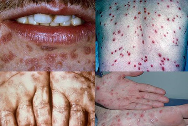 Show Hẹn hò và hôn: Giật mình hàng loạt bệnh sẽ lây khi hôn người lạ