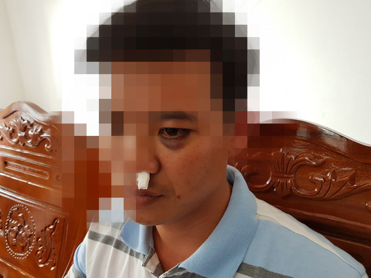 Học sinh dẫn người vào trường đánh thầy giáo gãy xương mũi