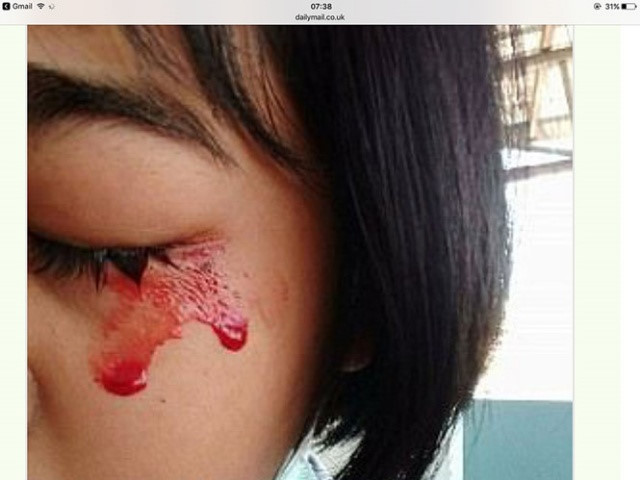 Mồ hôi máu - căn bệnh kỳ bí đối với y khoa thế giới