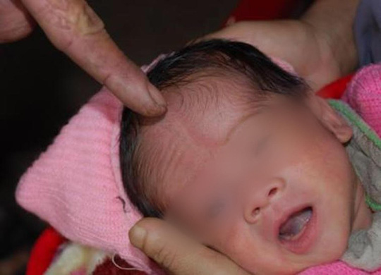 Bé trai 6 tháng tuổi nguy kịch sau khi được chữa mở khoá đầu