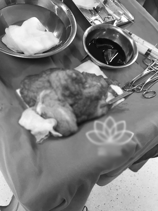 Lộ hình ảnh đầu tiên sau 4 ngày phẫu thuật của hotgirl ngực khủng ở Hải Dương