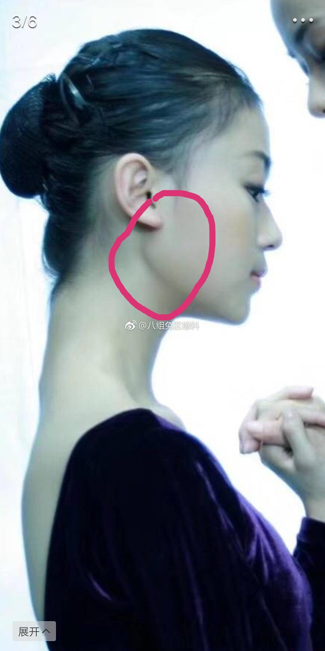 Ngụy Anh Lạc Ngô Cẩn Ngôn bị tố độn cằm, gọt mặt V-line, nhan sắc năm xưa khác xa bây giờ