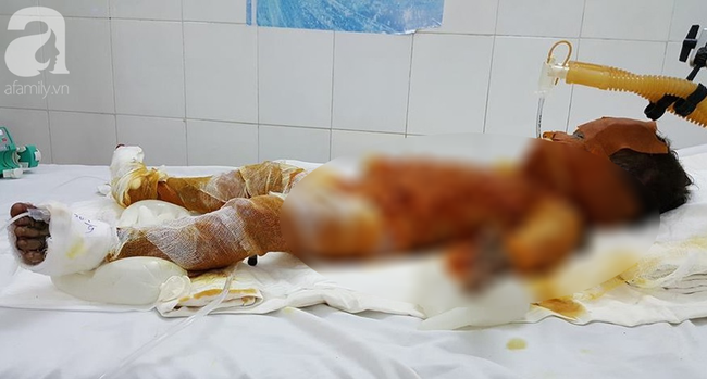 Sóc Trăng: Bố mẹ vắng nhà, 3 chị em chơi đốt rác khiến bé gái 20 tháng tuổi bỏng nặng đến 90%