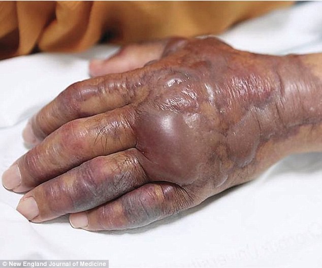 Bị cắt cụt tay chỉ vì ăn món khoái khẩu này: Chuyên gia cảnh báo một thói quen ăn uống dễ dẫn đến cái kết đắng!