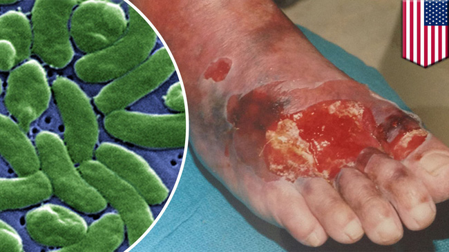 Bị cắt cụt tay chỉ vì ăn món khoái khẩu này: Chuyên gia cảnh báo một thói quen ăn uống dễ dẫn đến cái kết đắng!