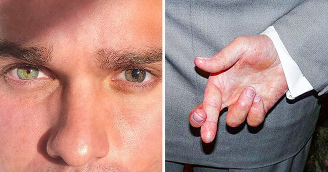 Siêu năng lực của những người mắc rối loạn lo âu - căn bệnh tưởng như thê thảm nhất thế giới Siêu năng lực của những người mắc rối loạn lo âu - căn bệnh tưởng như thê thảm nhất thế giới