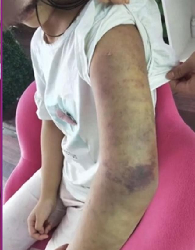 Mẹ kế hành hạ con gái riêng của chồng thân tàn ma dại, cơ thể rớm máu, người bố nhẫn tâm nói đánh thế là đúng