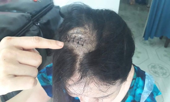 Đèn sân khấu rơi trúng đầu, bệnh viện chẩn đoán tai nạn giao thông