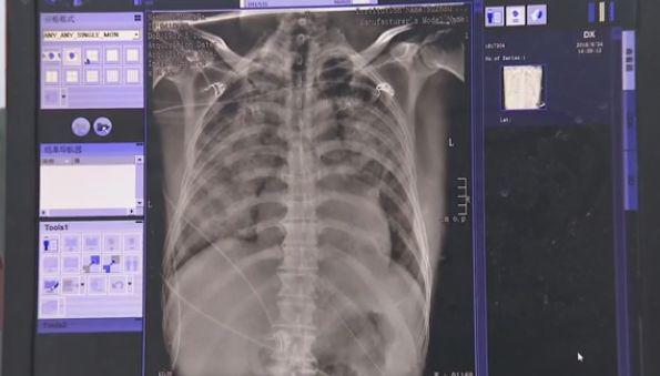 Người đàn ông chết sau 1 ngày nằm viện, thứ cướp đi sinh mạng của ông lại rất nhỏ bé