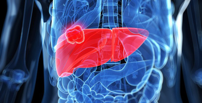 Mang tiếng không chồng mà chửa vì bụng to như mang bầu, người phụ nữ này đi khám mới chết lặng khi biết mắc phải bệnh cực nguy hiểm