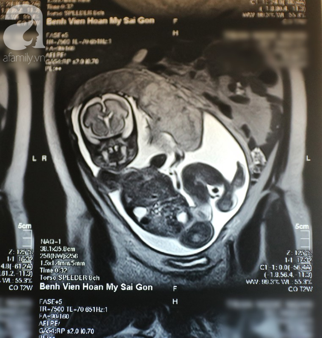 Mang thai 7 tháng nhưng bất ngờ đau bụng, người phụ nữ suýt mất con và có nguy cơ vô sinh vì căn bệnh nguy hiểm này