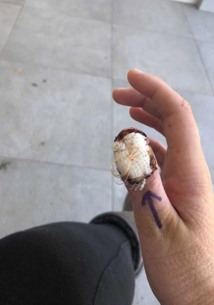 Cô gái 20 tuổi đã bị bệnh ung thư cực nguy hiểm do ngày nào cũng làm việc mà rất nhiều người vẫn làm vì tưởng là vô hại