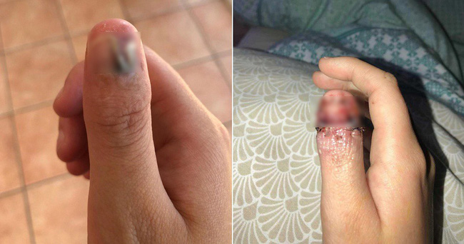 Cô gái 20 tuổi đã bị bệnh ung thư cực nguy hiểm do ngày nào cũng làm việc mà rất nhiều người vẫn làm vì tưởng là vô hại