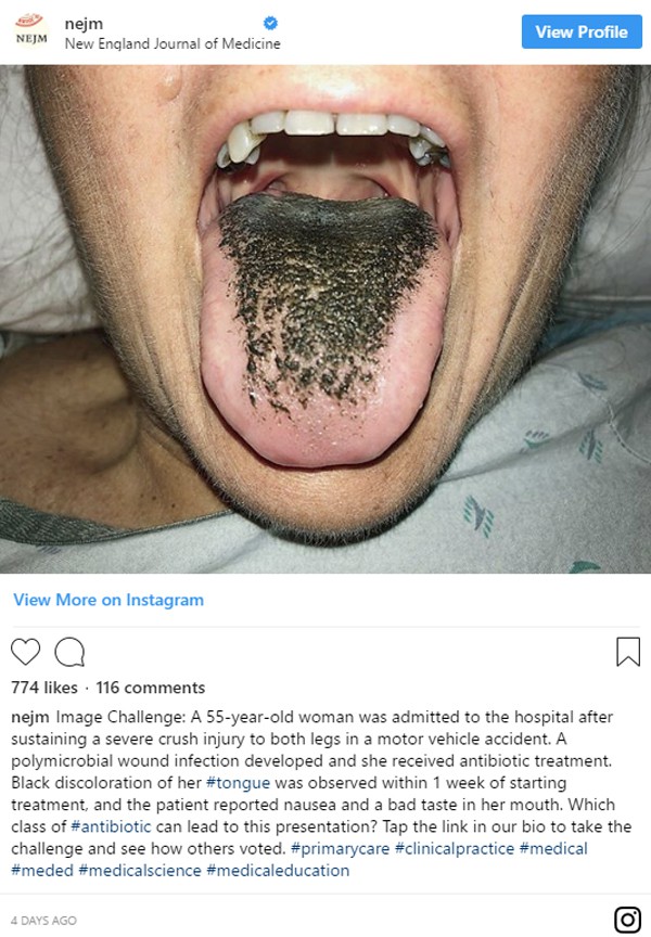 Người phụ nữ có lưỡi đen sì vì mọc lông: Chuyên gia cảnh báo thói quen mà nhiều người không để ý cũng là nguyên nhân gây bệnh