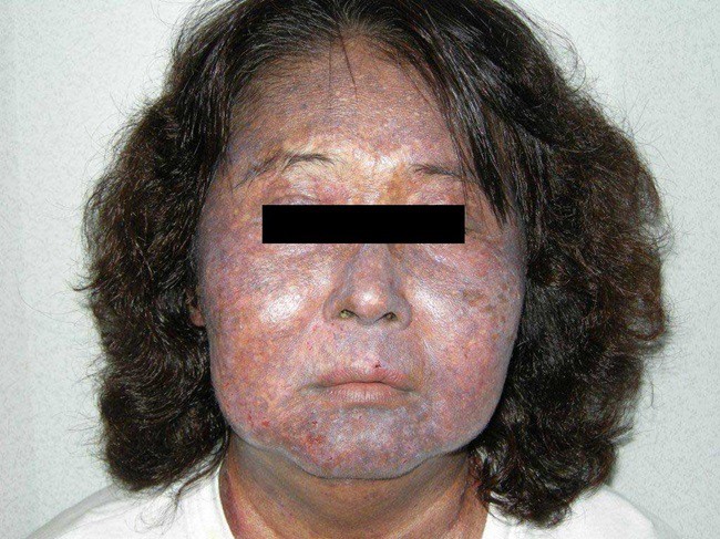 Sử dụng sản phẩm tẩy trắng da - tiền mất tật mang