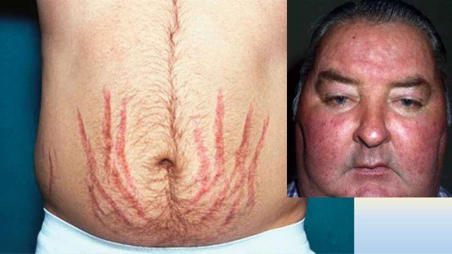 Sử dụng sản phẩm tẩy trắng da - tiền mất tật mang