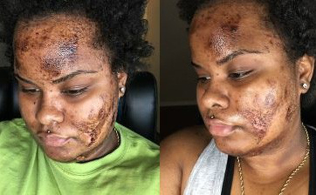 Sử dụng sản phẩm tẩy trắng da - tiền mất tật mang