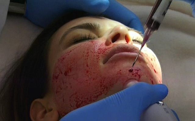 Làm đẹp bằng máu: Nên hay không nên?