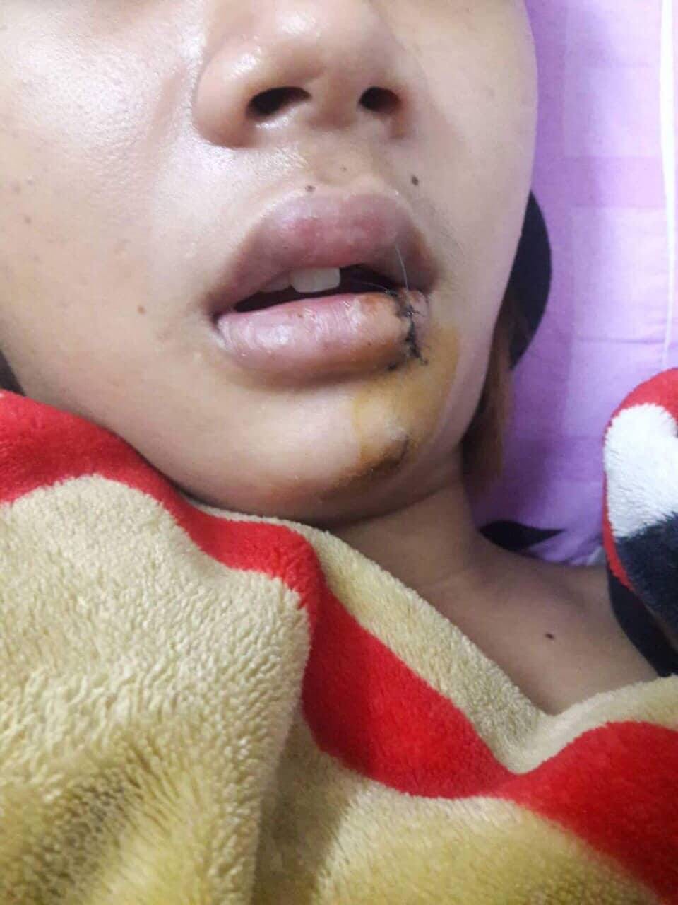 Thiếu nữ 14 tuổi kể lại thời khắc kinh hoàng khi bị nhóm thanh niên chặn đường truy sát giữa đêm ở Sài Gòn