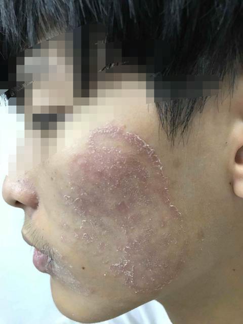 Hãi hùng mặt lở loét, mọc đầy lông vì dùng kem trộn chữa trứng cá, nám má