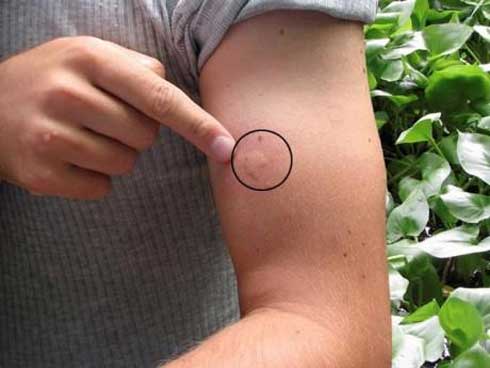 Chàng trai 24 tuổi bị muỗi cắn 1 tuần không lành, đi khám bác sĩ kết luận gây sốc