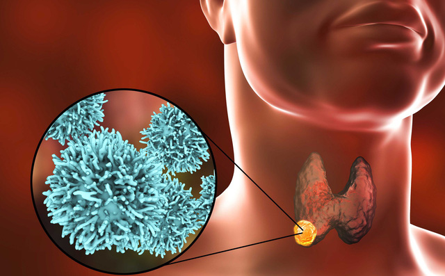 Thấy 5 dấu hiệu này, bạn nên đi khám vì ung thư tuyến giáp đang lớn dần trong cơ thể