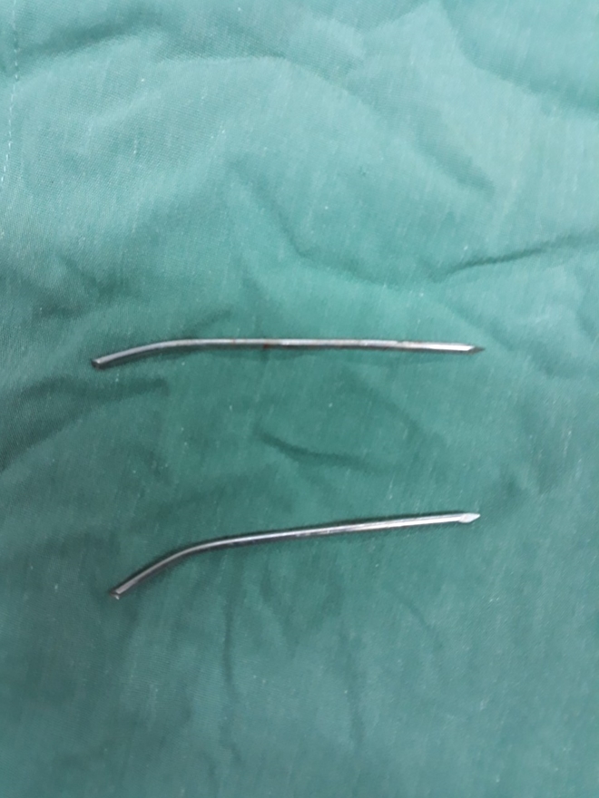 Người đàn ông bị đinh đâm xuyên thực quản, khí quản