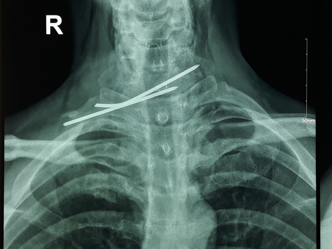 Người đàn ông bị đinh đâm xuyên thực quản, khí quản