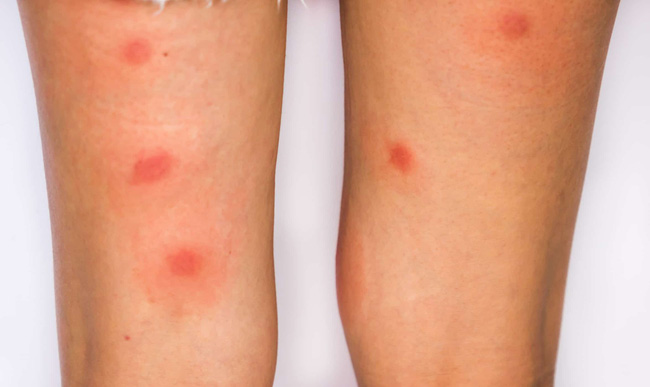 Người đàn ông suýt mất mạng vì làm điều này khi nuôi mèo, bác sĩ cảnh báo bệnh nguy hiểm ai cũng cần cảnh giác