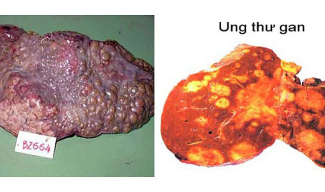 Bác sĩ Bệnh viện K chia sẻ các dấu hiệu vàng cảnh báo bệnh ung thư gan