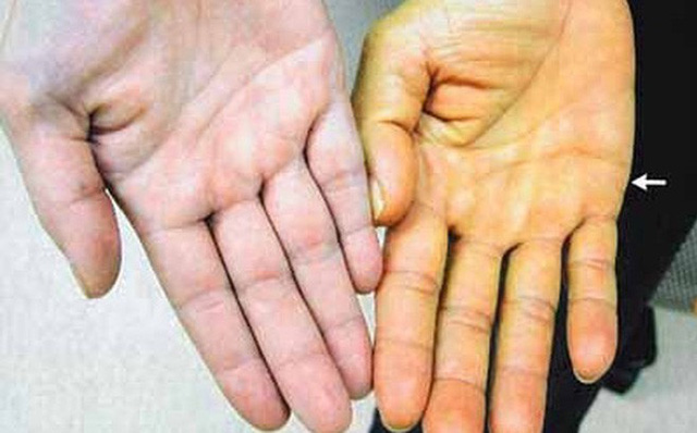 Bác sĩ Bệnh viện K chia sẻ các dấu hiệu vàng cảnh báo bệnh ung thư gan