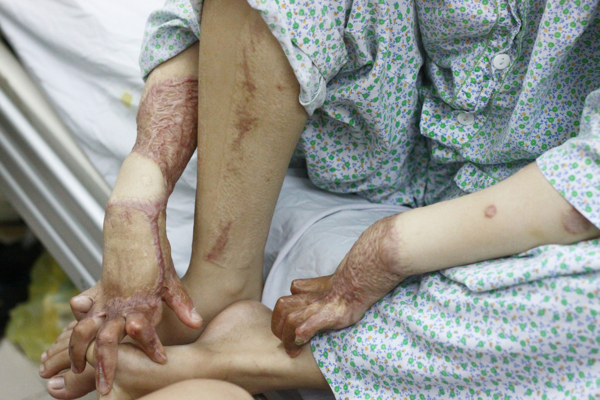 Sau 1 năm và hàng chục cuộc phẫu thuật, người vợ Hà Nội bị chồng thiêu hôm mùng 2 Tết, chỉ có 1% cơ hội sống sót đã hồi sinh Sau 1 năm và hàng chục cuộc phẫu thuật, người vợ Hà Nội bị chồng thiêu hôm mùng 2 Tết, chỉ có 1% cơ hội sống sót đã hồi sinh