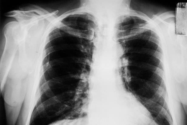 Người phụ nữ này bị ung thư phổi ở tuổi 31, nguyên nhân do chính thứ ẩn nấp trong nhà mà không ai nhìn thấy