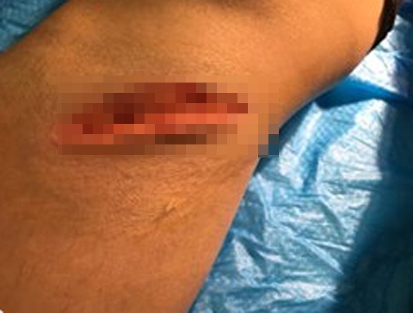 Vì ghen tuông, nữ hộ lý bị chồng dụ lên đồi đánh đập dã man, cắt gân chân