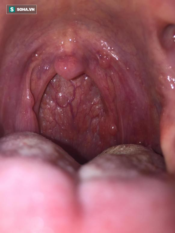 Có dấu hiệu chết người này không khỏi sau 2 - 3 tuần, hãy cẩn trọng với ung thư cổ họng