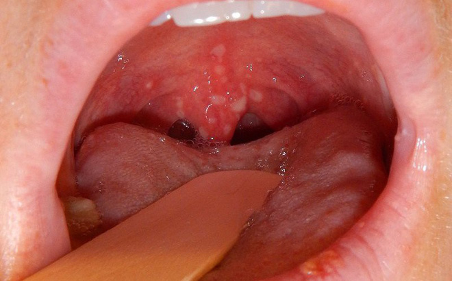 Có dấu hiệu chết người này không khỏi sau 2 - 3 tuần, hãy cẩn trọng với ung thư cổ họng